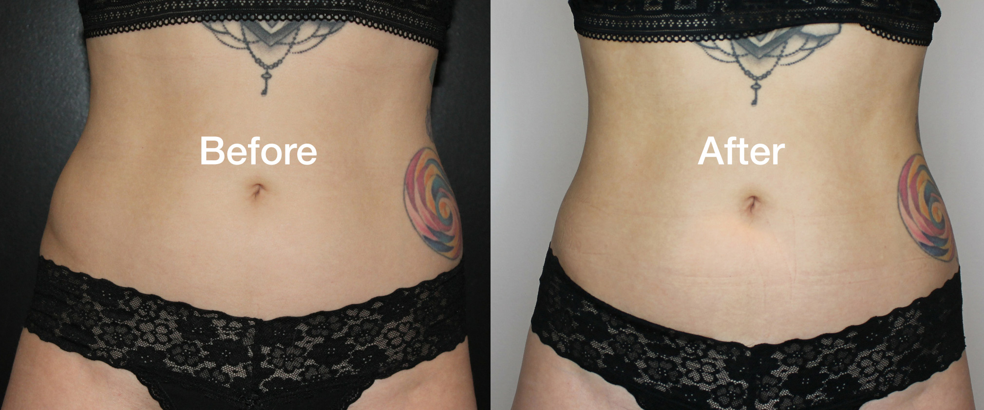 Coolsculpting Before & Afters - reduce fat at Vibe Medi Spa in Bedford NS