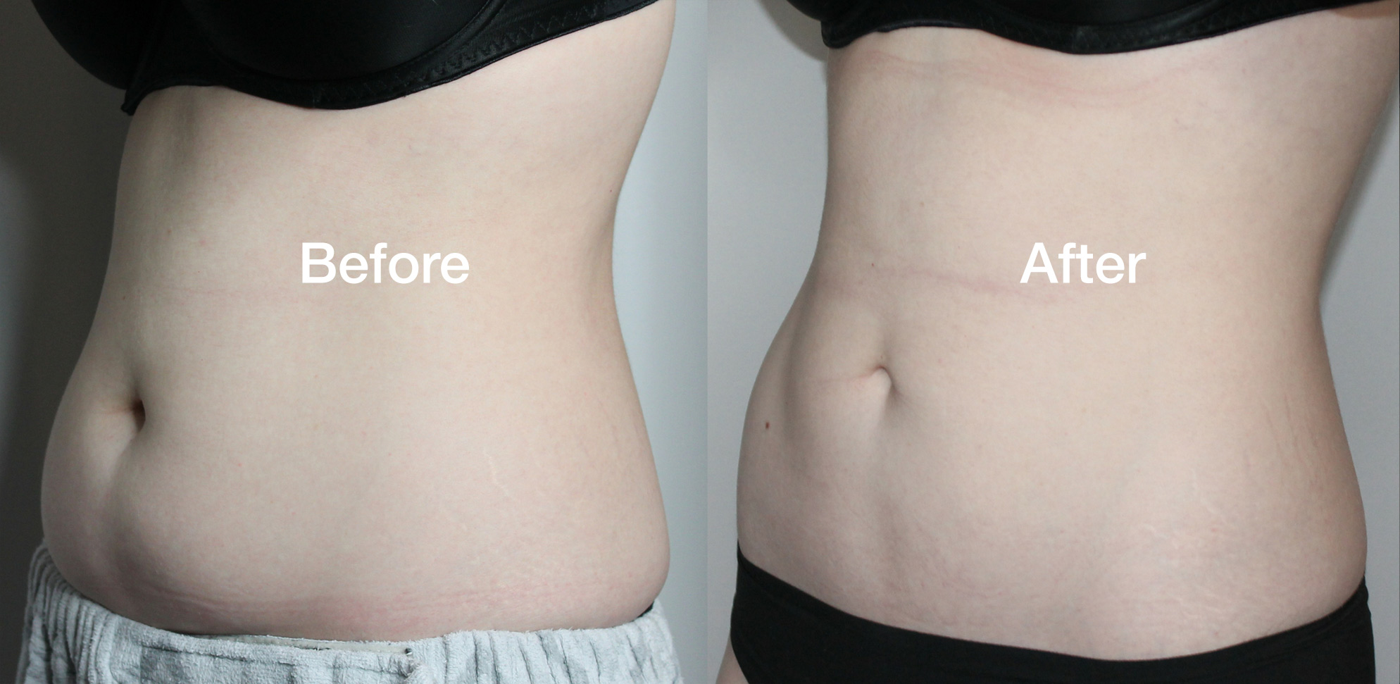 Coolsculpting Before & Afters - reduce fat at Vibe Medi Spa in Bedford NS